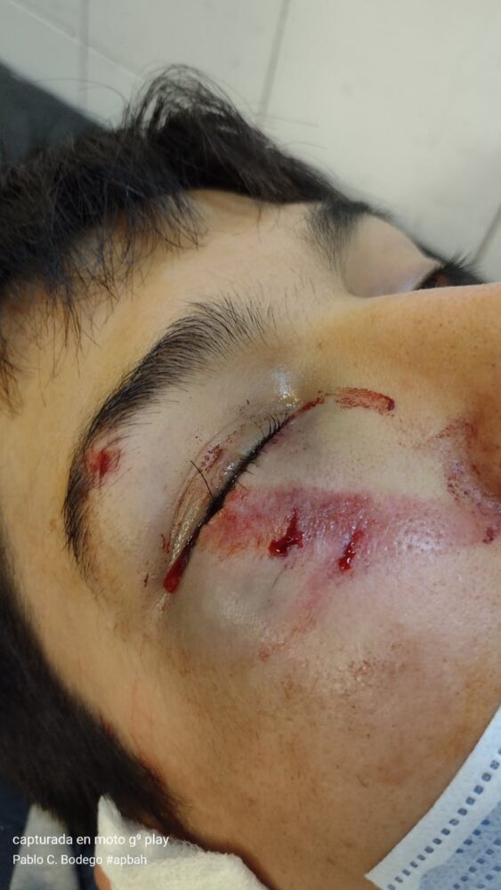 Accidente en Tapiales: Peligró la vida de un adolescente